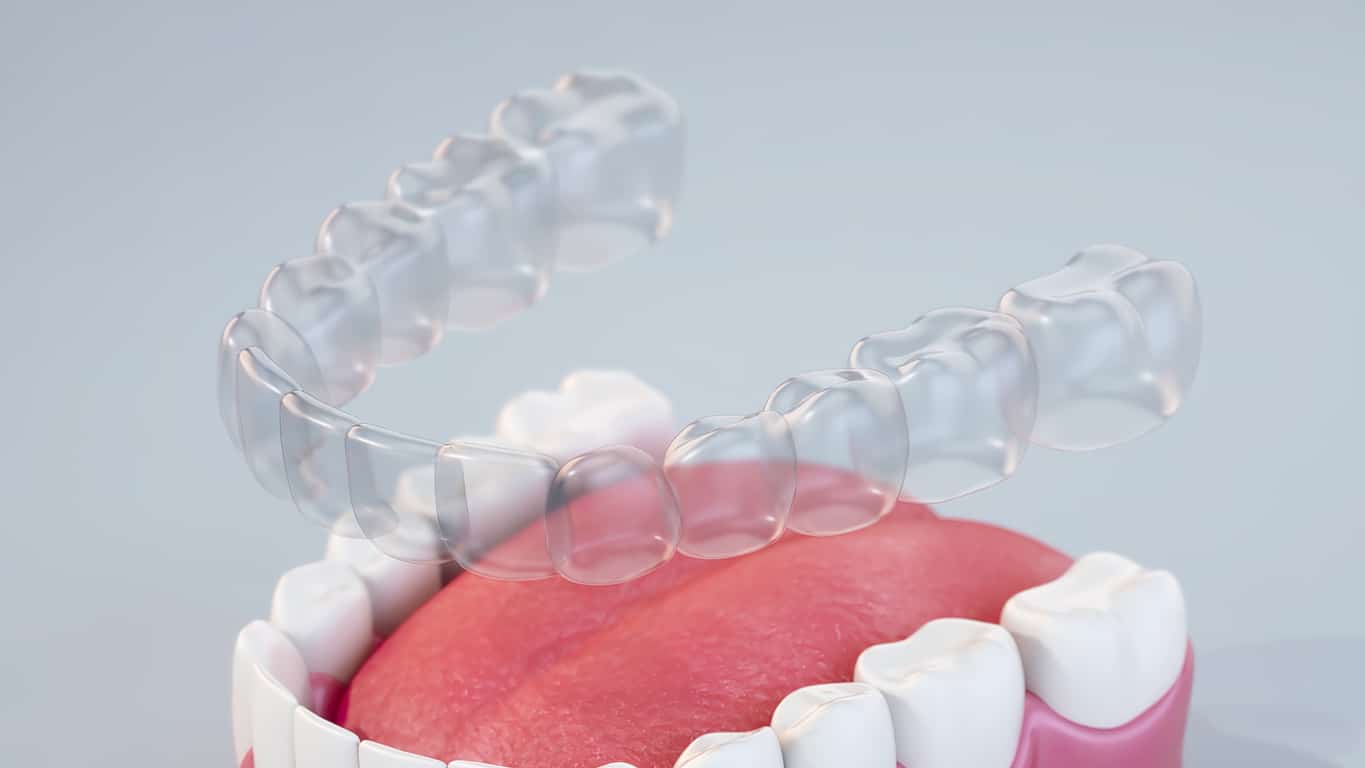 Clear aligners over dental model in clear aligners section at Obaisi Orthodontics in Chicago, IL